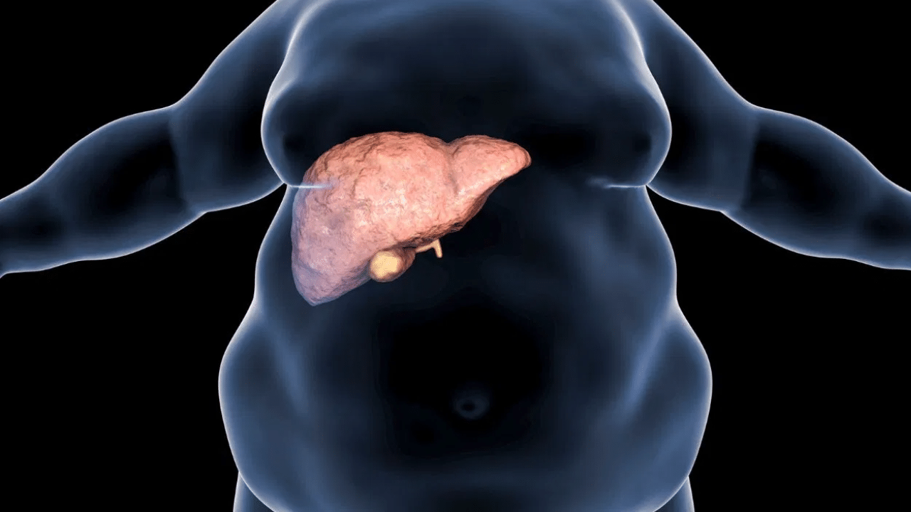 Fatty Liver : ஃபேட்டி லிவர் பிரச்னை உள்ளவர்கள் இனிப்பு சாப்பிடலாமா? மருத்துவர்கள் சொல்வது என்ன? Fatty Liver : ஃபேட்டி லிவர் பிரச்னை உள்ளவர்கள் இனிப்பு சாப்பிடலாமா? மருத்துவர்கள் சொல்வது என்ன?