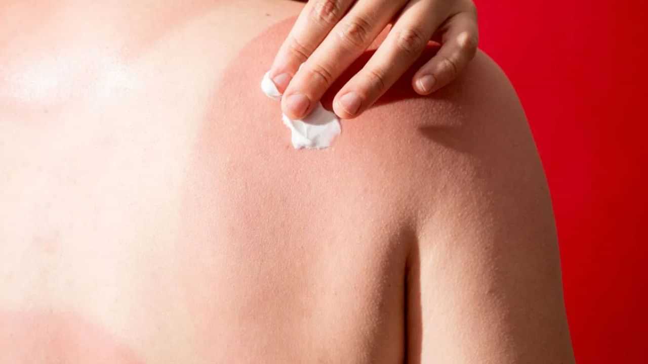 Summer Sunburn : வெயிலால் ஏற்படும் தோல் எரிச்சல்... டாக்டர் சொல்லும் முக்கிய அறிவுரைகள்!