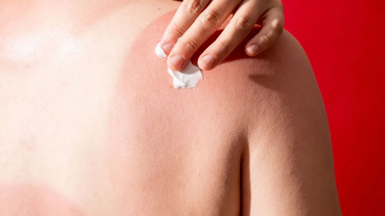 Summer Sunburn : வெயிலால் ஏற்படும் தோல் எரிச்சல்… டாக்டர் சொல்லும் முக்கிய அறிவுரைகள்!