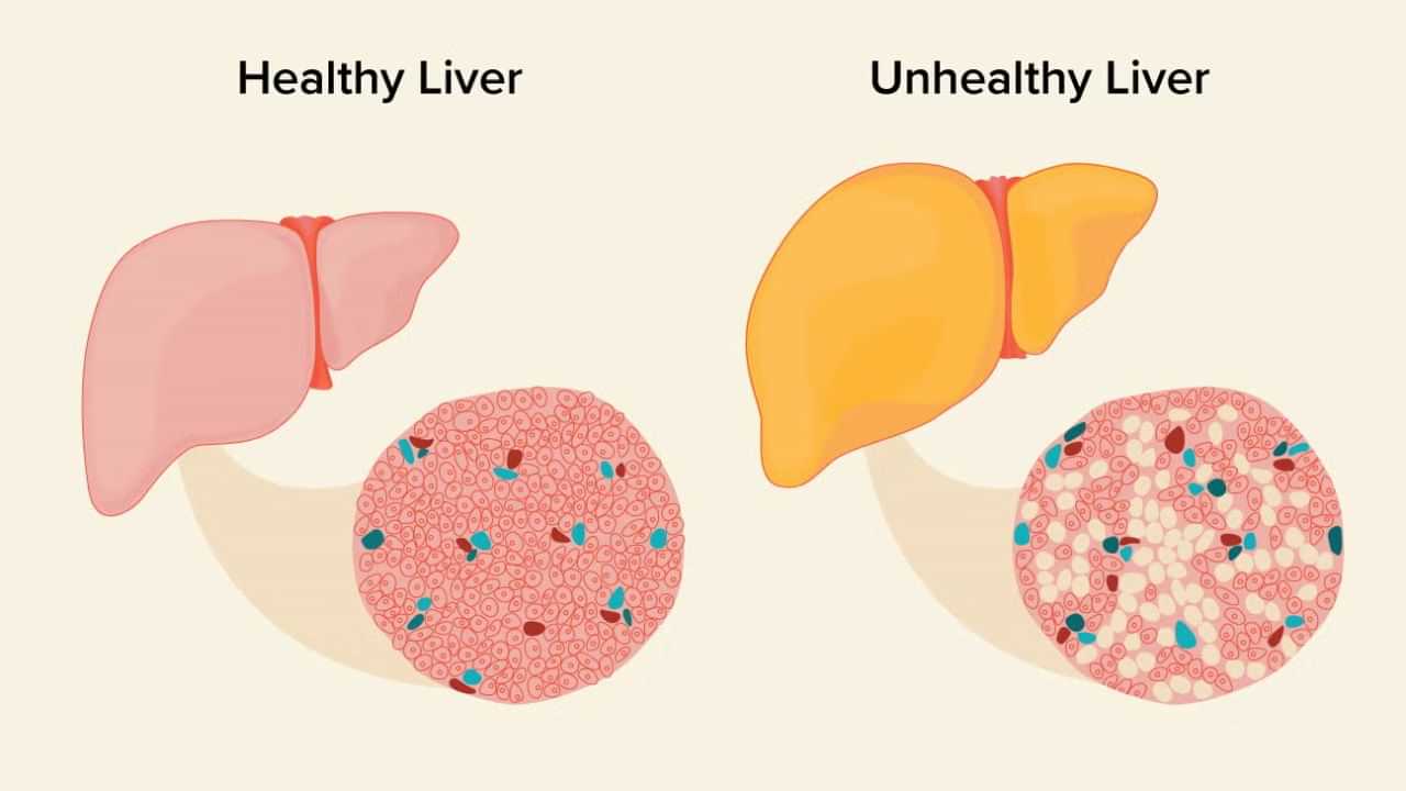 Fatty Liver: ஃபேட்டி லிவர் நோயாளிகள் தவிர்க்க வேண்டியதும் சேர்க்க வேண்டியதும்: