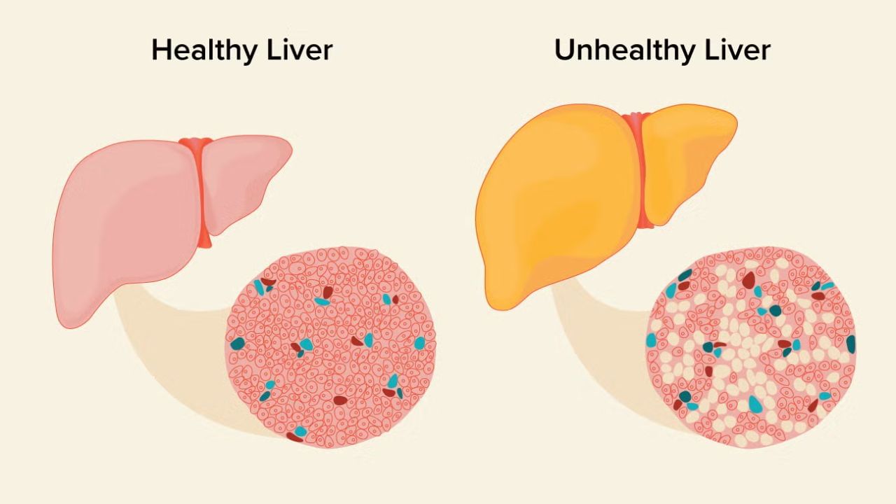 Fatty Liver: ஃபேட்டி லிவர் நோயாளிகள் தவிர்க்க வேண்டியதும் சேர்க்க வேண்டியதும்: Fatty Liver: ஃபேட்டி லிவர் நோயாளிகள் தவிர்க்க வேண்டியதும் சேர்க்க வேண்டியதும்:
