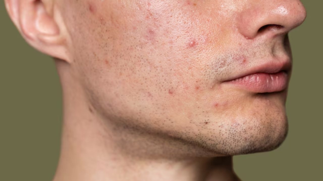 Pimples and Gut Health: முகத்தில் பருக்கள் ஏன் தோன்றுகிறது..? இதற்கும் வயிற்றுக்கும் என்ன சம்பந்தம்..? Pimples and Gut Health: முகத்தில் பருக்கள் ஏன் தோன்றுகிறது..? இதற்கும் வயிற்றுக்கும் என்ன சம்பந்தம்..?