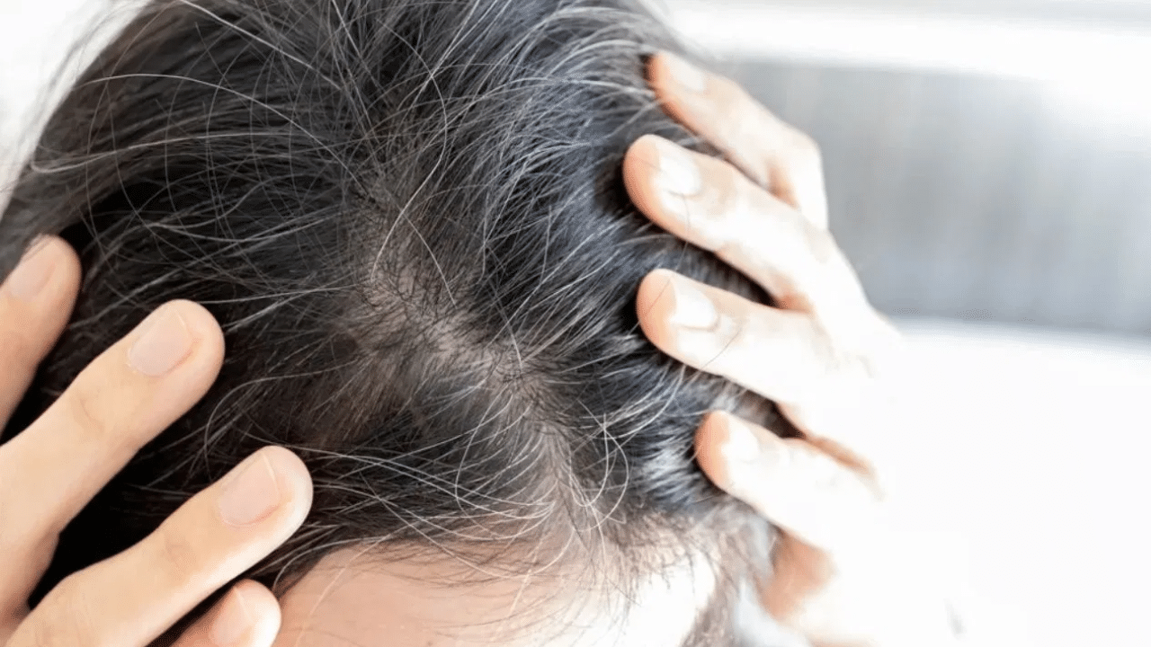 இளநரை பிரச்னையா? – இயற்கை முறையில் சரி செய்வது எப்படி?