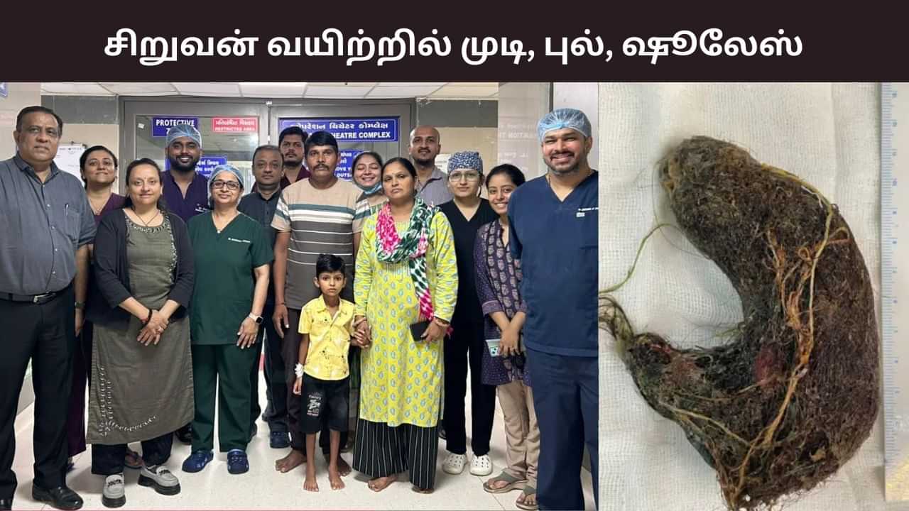 7 வயது சிறுவனின் குடலில் இருந்து முடி, புல், ஷூலேஸ் அகற்றம்.. ட்ரைக்கோபெசோவர் என்றால் என்ன? 7 வயது சிறுவனின் குடலில் இருந்து முடி, புல், ஷூலேஸ் அகற்றம்.. ட்ரைக்கோபெசோவர் என்றால் என்ன?