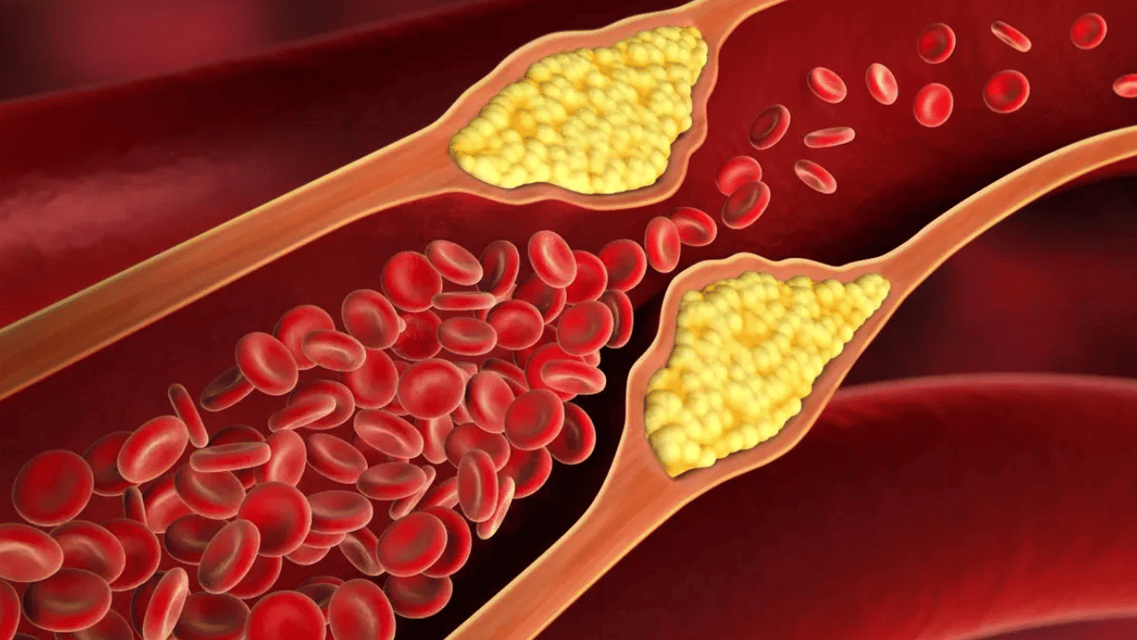உங்கள் முகத்தில் இந்த அறிகுறிகள் இருக்கா? உடலில் கொலஸ்ட்ரால் அதிகம் இருக்கலாம்! உங்கள் முகத்தில் இந்த அறிகுறிகள் இருக்கா? உடலில் கொலஸ்ட்ரால் அதிகம் இருக்கலாம்!