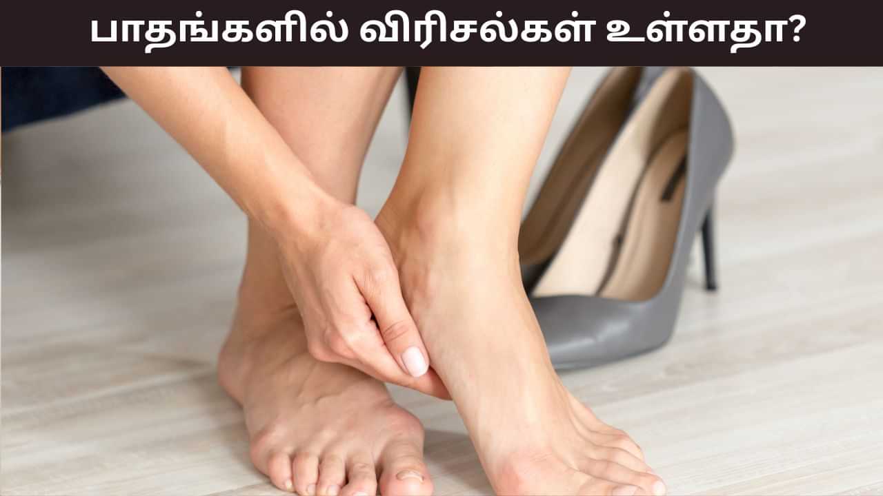 Cracked Heels: மழைக்காலத்தில் கால் பாதத்தில் வெடிப்புடன் வலியா..? இந்த பொருட்கள் எளிதில் குணமாக்கும்! Cracked Heels: மழைக்காலத்தில் கால் பாதத்தில் வெடிப்புடன் வலியா..? இந்த பொருட்கள் எளிதில் குணமாக்கும்!