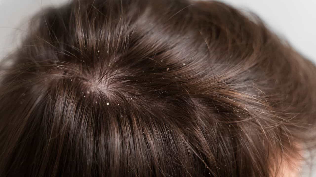Dandruff Control Tips: மழைக்காலத்தில் அதிகரிக்கும் பொடுகு பிரச்சனை.. இதை எவ்வாறு தடுப்பது..? Dandruff Control Tips: மழைக்காலத்தில் அதிகரிக்கும் பொடுகு பிரச்சனை.. இதை எவ்வாறு தடுப்பது..?