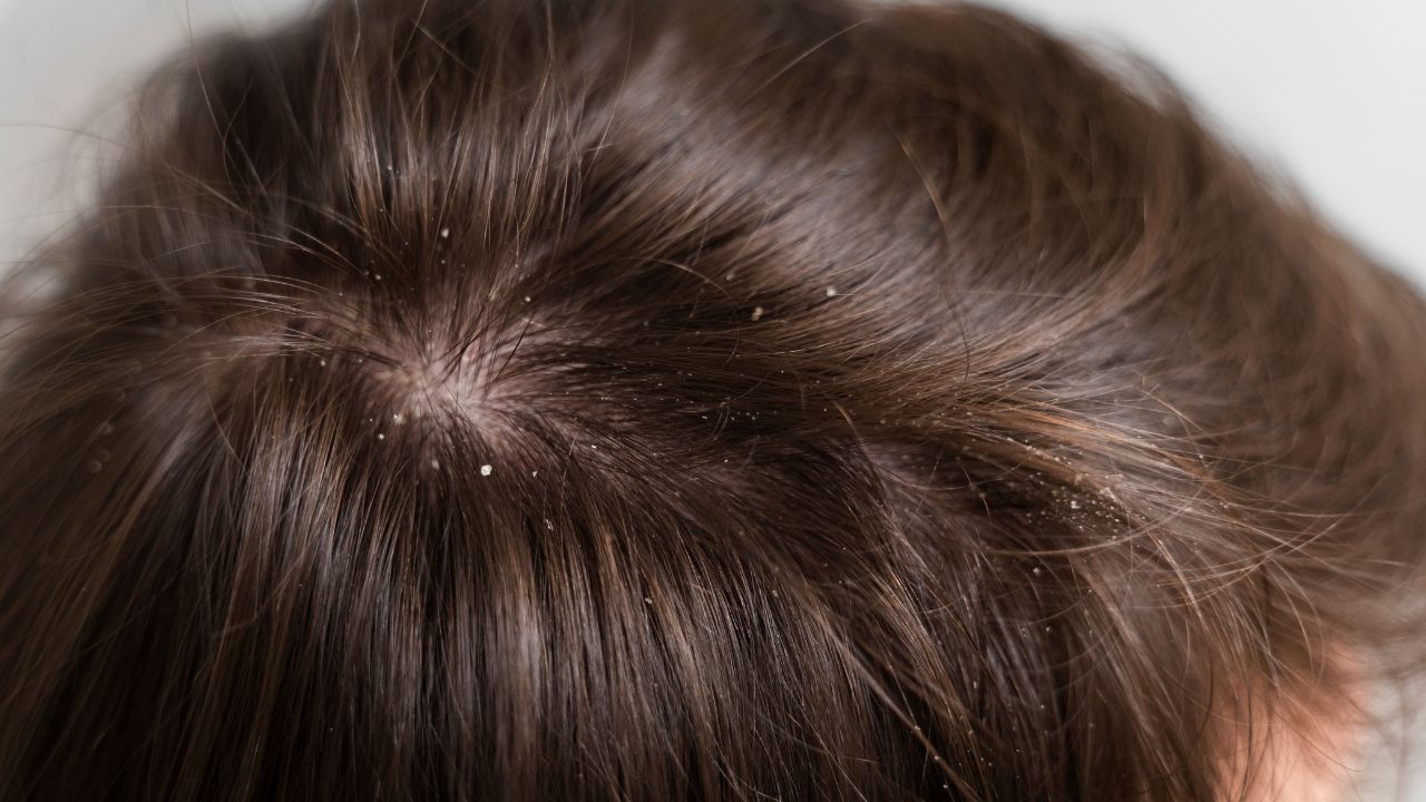 Dandruff Control Tips: மழைக்காலத்தில் அதிகரிக்கும் பொடுகு பிரச்சனை.. இதை எவ்வாறு தடுப்பது..?
