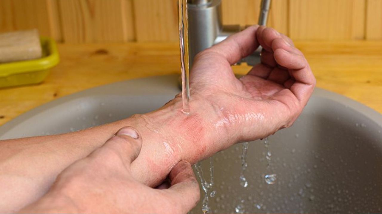 Kitchen Burns: சூடான எண்ணெய், நீராவியால் தீக்காயமா..? உடனடியாக என்ன செய்யலாம்..? என்ன செய்யக்கூடாது? Kitchen Burns: சூடான எண்ணெய், நீராவியால் தீக்காயமா..? உடனடியாக என்ன செய்யலாம்..? என்ன செய்யக்கூடாது?