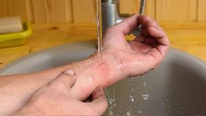 Kitchen Burns: சூடான எண்ணெய், நீராவியால் தீக்காயமா..? உடனடியாக என்ன செய்யலாம்..? என்ன செய்யக்கூடாது?