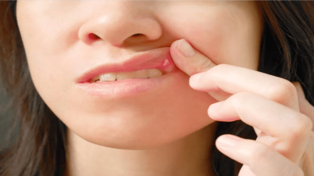 அடிக்கடி வாய் புண்கள் ஏற்படுகிறதா? இதுதான் காரணம்! அடிக்கடி வாய் புண்கள் ஏற்படுகிறதா? இதுதான் காரணம்!