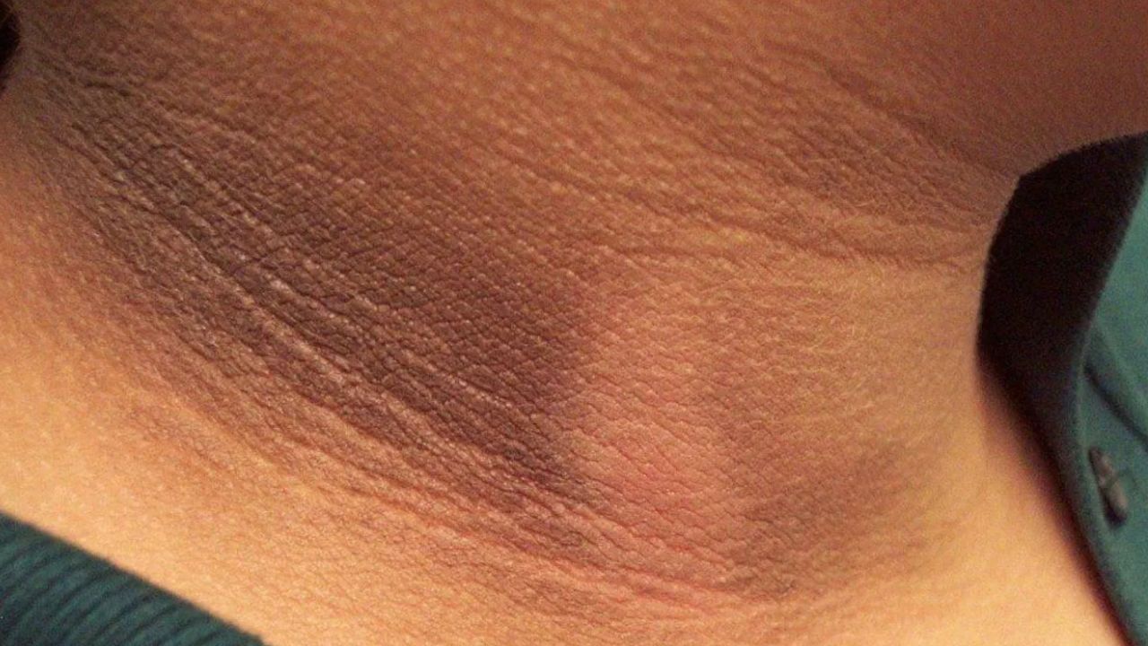 Beauty Tips: கழுத்தில் உள்ள கருமையான வடுவால் கவலையா..? இவை உங்கள் பிரச்சனையை சரிசெய்யும்!