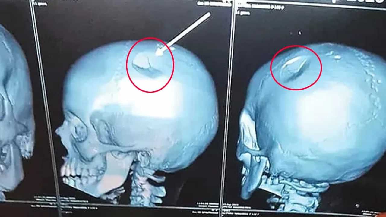 ஆசிரியரால் சிறுமிக்கு நேர்ந்த கொடுமை.. உடைந்தது மண்டை ஓடு... மருத்துவமனையில் சிகிச்சை! ஆசிரியரால் சிறுமிக்கு நேர்ந்த கொடுமை.. உடைந்தது மண்டை ஓடு... மருத்துவமனையில் சிகிச்சை!