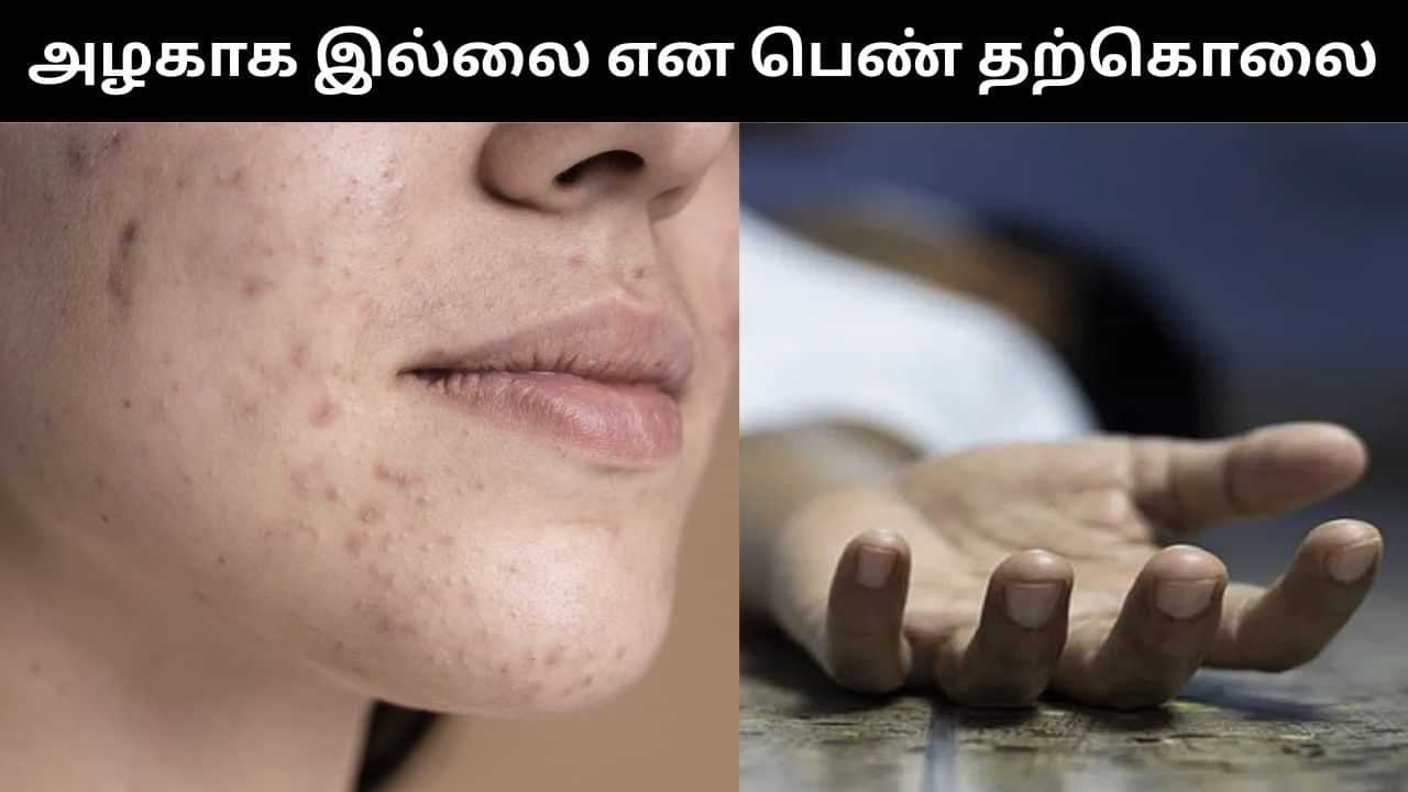 முகத்தில் இருந்த கரும்புள்ளிகள்.. தான் அழகாக இல்லை என நினைத்து பெண் விபரீதம்.. அதிர்ச்சி சம்பவம்!