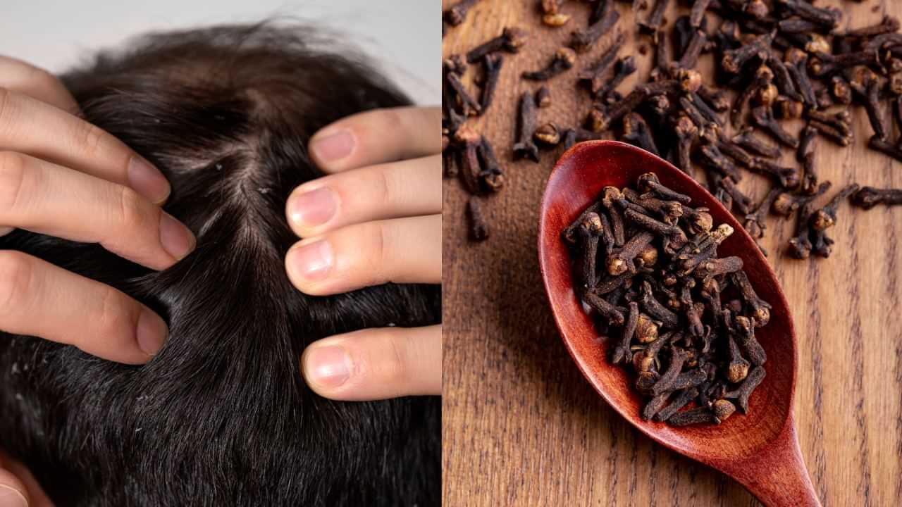 Dandruff Control: 4 கிராம்பு போதும்! தலைமுடியில் இருந்து பொடுகு காணாமல் போகும்..! Dandruff Control: 4 கிராம்பு போதும்! தலைமுடியில் இருந்து பொடுகு காணாமல் போகும்..!