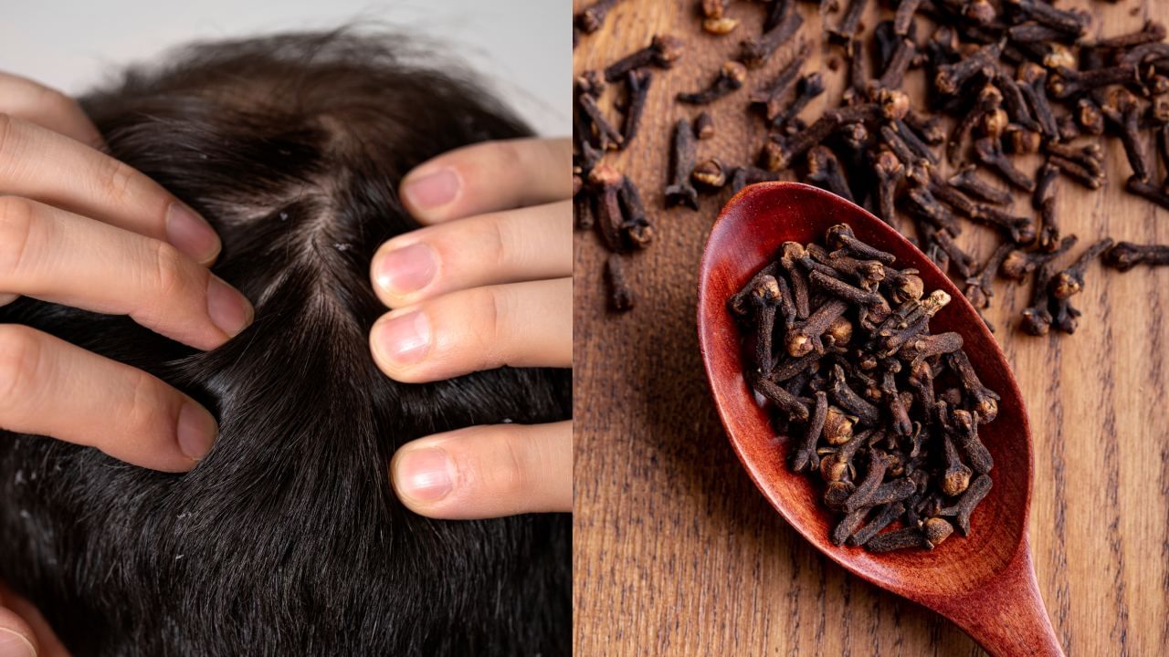 Dandruff Control: 4 கிராம்பு போதும்! தலைமுடியில் இருந்து தலைமுடி காணாமல் போகும்..! Dandruff Control: 4 கிராம்பு போதும்! தலைமுடியில் இருந்து தலைமுடி காணாமல் போகும்..!