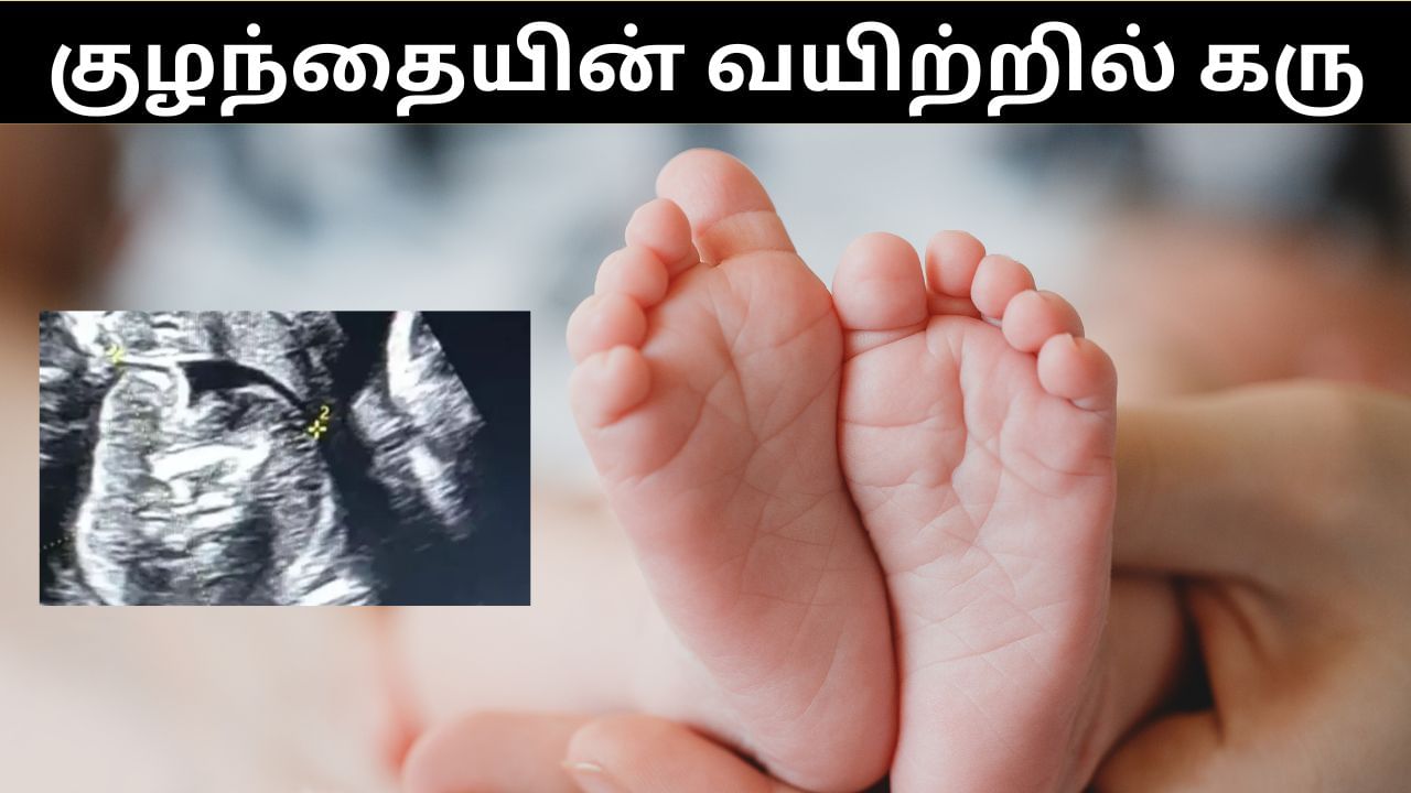 பிறந்த குழந்தையின் வயிற்றில் கரு.. முதுகெலும்பு வளர்ந்திருப்பதாக மருத்துவர்கள் அதிர்ச்சி தகவல்! பிறந்த குழந்தையின் வயிற்றில் கரு.. முதுகெலும்பு வளர்ந்திருப்பதாக மருத்துவர்கள் அதிர்ச்சி தகவல்!