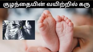 பிறந்த குழந்தையின் வயிற்றில் கரு.. முதுகெலும்பு வளர்ந்திருப்பதாக மருத்துவர்கள் அதிர்ச்சி தகவல்!