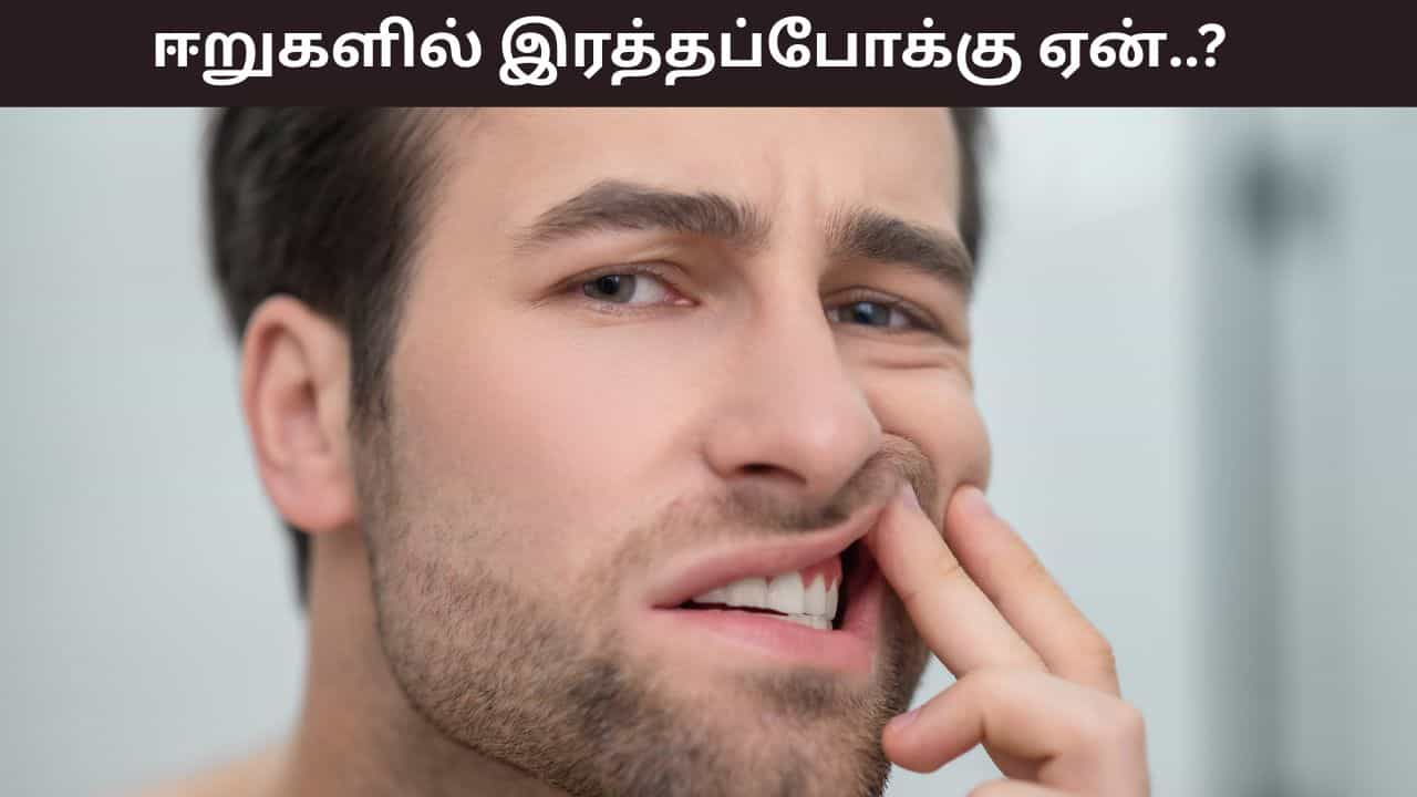 Bleeding Gum: ஈறுகளில் இரத்தப்போக்கு பிரச்சனையா? இது எதனால் ஏற்படுகிறது..? Bleeding Gum: ஈறுகளில் இரத்தப்போக்கு பிரச்சனையா? இது எதனால் ஏற்படுகிறது..?