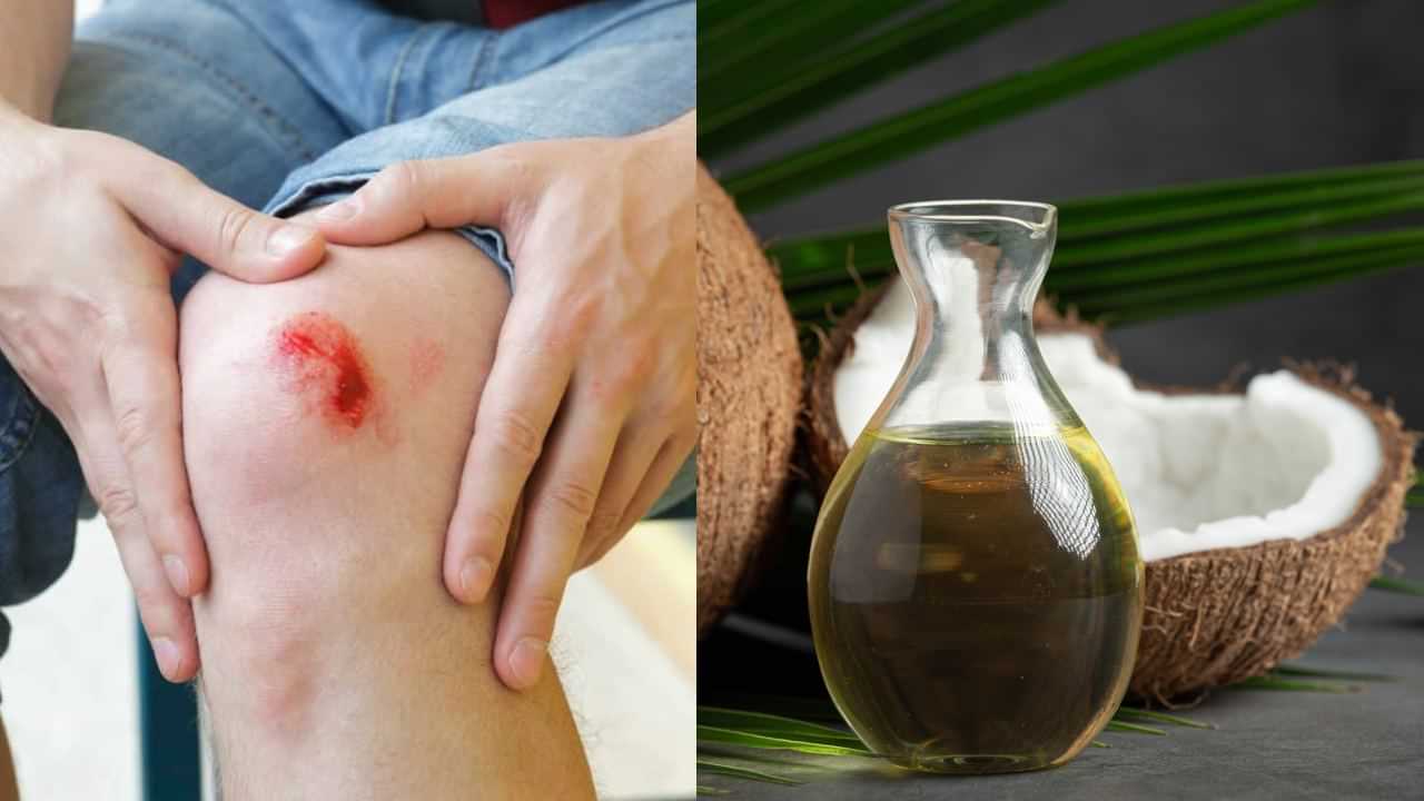 Health Tips: காயத்தின் மீது தேங்காய் எண்ணெயை தடவலாமா..? மருத்துவர் சரவணன் விளக்கம்! Health Tips: காயத்தின் மீது தேங்காய் எண்ணெயை தடவலாமா..? மருத்துவர் சரவணன் விளக்கம்!