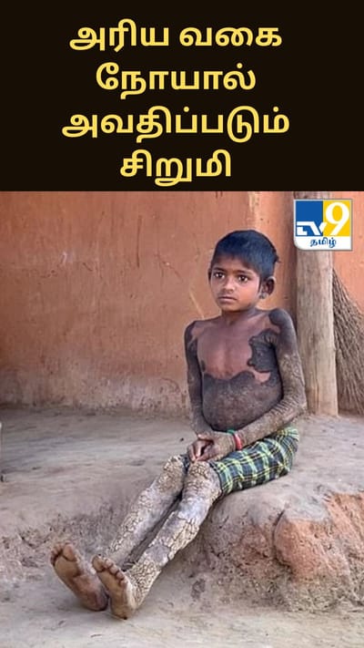 உடலை கல்லாக மாற்றக்கூடிய கொடிய நோய்.. 7 வயது சிறுமியின் வேதனை கதை