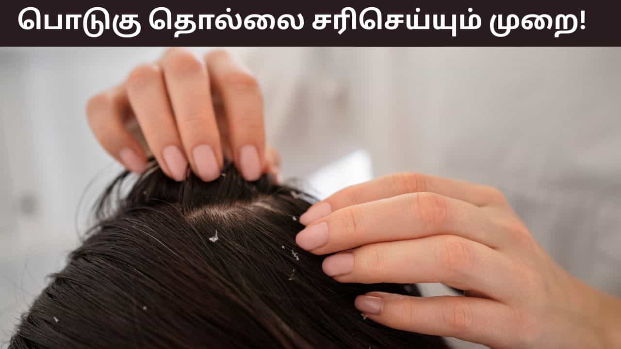 Dandruff Problems: பொடுகு தொல்லையா..? எண்ணெய் தேய்த்தும் பலன் இல்லையா? சில டிப்ஸ் இதோ! Dandruff Problems: பொடுகு தொல்லையா..? எண்ணெய் தேய்த்தும் பலன் இல்லையா? சில டிப்ஸ் இதோ!
