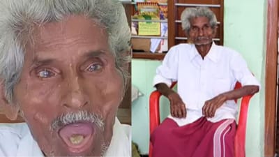 69 ஆண்டுகளாக வாயில் கல்லுடன் வாழும் முதியவர்!