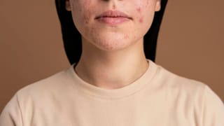 Skin Care: முகப்பருவால் முகம் முழுவதும் குழிகள்.. கவலை வேண்டாம்! இந்த தீர்வுகள் சரிசெய்யும்!