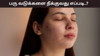 பருக்கள் வந்து முகத்தில் வடுக்களா..? சரிசெய்யும் 6 எளிய டிப்ஸ்!...