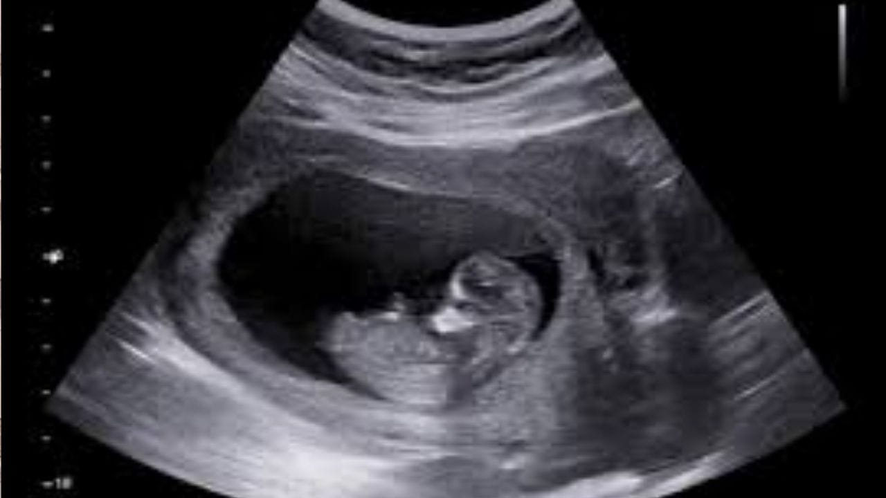 தற்போது, இந்தியாவில் இந்த சட்டம் அமலில் இருப்பதால், இந்தியாவில் இருந்து சிலர் வெளிநாடுகளுக்கு சென்று கருவில் இருக்கும் சிசுவின் பாலினத்தை கண்டறிந்து வருகின்றனர். அதற்கும் தடை விதிக்க வேண்டும் என்று தமிழக மக்கள் நல்வாழ்வுத் துறை பரிந்துரை செய்துள்ளது குறிப்பிடத்தக்கது.