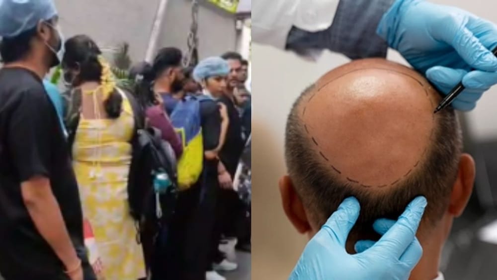 12ஆம் வகுப்பு மட்டுமே படித்து முடி மாற்று சிகிச்சை..