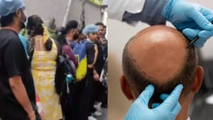 12ஆம் வகுப்பு மட்டுமே படித்து முடி மாற்று சிகிச்சை.. சென்னையில் சிக்கிய வட மாநில போலி மருத்துவர்கள்..