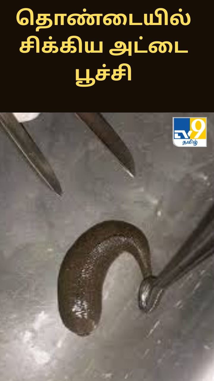 தொண்டையில் சிக்கிய அட்டை பூச்சி - 55 வயது நபரின் உயிரைக் காப்பாற்றிய மருத்துவர்கள்