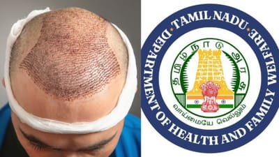 முடி மாற்று சிகிச்சை மையங்களுக்கு புதிய விதிகள் வெளியீடு!