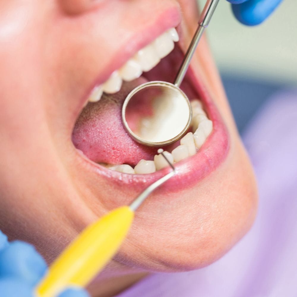 வாயில் உள்ள பாக்டீரியாக்கள் இரத்த ஓட்டம் வழியாக உடலுக்குள் கொண்டு செல்லப்பட்டு, காலப்போக்கில் இதயத்தைப் பாதிக்கும் வீக்கத்தை ஏற்படுத்துகின்றன. பல் துலக்காமல் இருப்பது நேரடியாக இதய நோயை ஏற்படுத்தாது என்றாலும், இதயப் பிரச்சினைகளுக்கு பங்களிக்கும் பல ஆபத்து காரணிகளை உண்டாக்கலாம்.