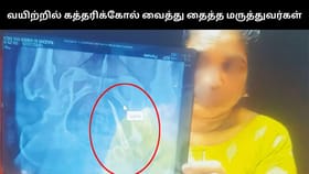 பெண்ணின் வயிற்றில் கத்தரிக்கோல் வைத்து தைத்த மருத்துவர்கள்.. 5 ஆண்டுகளுக்கு பிறகு வெளிசத்திற்கு வந்த சம்பவம்!...
