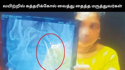 பெண்ணின் வயிற்றில் கத்தரிக்கோல் வைத்து தைத்த மருத்துவர்கள்!