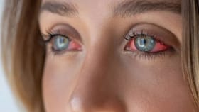 “ஒரு நாளைக்கு 5 பேர்”.. தமிழகத்தில் அதிகரித்து வரும் மெட்ராஸ் ஐ பாதிப்பு… மருத்துவர்கள் விடுத்த எச்சரிக்கை!...