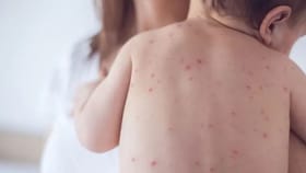 சின்னம்மை நோய் பரவல்.. பொது மக்களுக்கு சுகாதார துறை அறிவுறுத்தல்.....