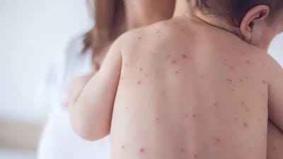 சின்னம்மை நோய் பரவல்.. பொது மக்களுக்கு சுகாதார துறை அறிவுறுத்தல்