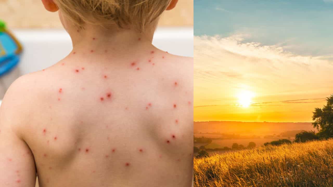 கோடைகாலத்தால் சின்னம்மை நோய் அதிகரிப்பு.. தற்காத்துக்கொள்வது எப்படி?