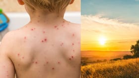 கோடைகாலத்தால் சின்னம்மை நோய் அதிகரிப்பு.. தற்காத்துக்கொள்வது எப்படி?...