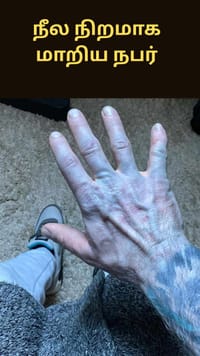 தூங்கி எழுந்ததும் நீல நிறமாக மாறிய நபர் - என்ன நடந்தது?...