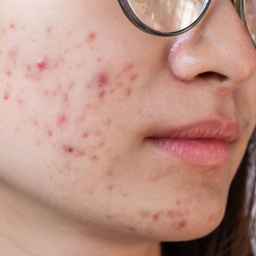 மீன்: சில மீன் வகைகள் உடலில் அலர்ஜி எதிர்வினையை ஏற்படுத்தும் வாய்ப்பு உள்ளது. குறிப்பாக கருவாடாக பதப்படுத்தப்பட்ட மீன்களில் இந்த பாதிப்பு அதிகமாக இருக்கலாம். இதனால் சருமத்தில் அரிப்பு, சிவப்பு மற்றும் எரிச்சல் போன்றவை தோன்றும். புதிய மீனைத் தேர்வு செய்து அளவோடு சாப்பிடுவது நல்லது.