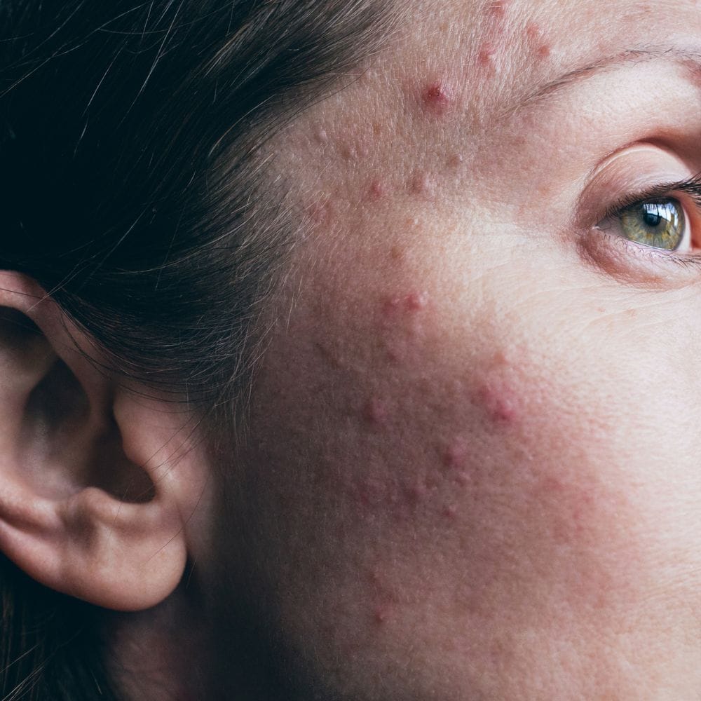 கோதுமை: கோதுமையில் உள்ள குளுட்டன் சிலருக்கு செரிமான மற்றும் சரும பிரச்சினைகளை உருவாக்கும். இது உடலில் அழற்சியை தூண்டி, சருமத்தில் வறட்சி மற்றும் அரிப்பு போன்ற அறிகுறிகளை ஏற்படுத்தும். குளுட்டன் சென்சிட்டிவிட்டி உள்ளவர்களுக்கு இது மிகவும் பாதிப்பு தரக்கூடியது.