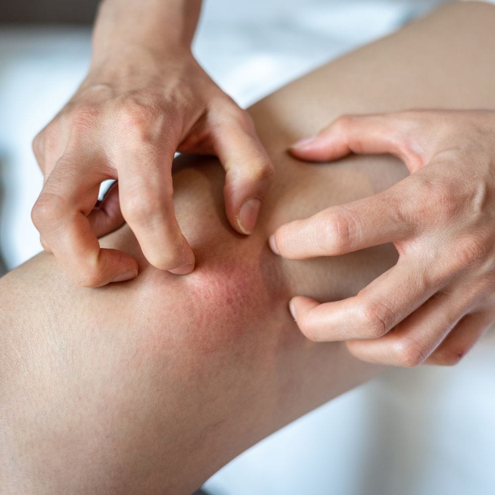 முட்டை: முட்டையில் உள்ள புரதங்கள் சிலருக்கு அலர்ஜி ஏற்படுத்தக்கூடியவை. இதனால் சருமத்தில் சொறி, சிரங்கு, சிவப்பு தழும்புகள் போன்றவை தோன்றலாம். குழந்தைகள் மற்றும் இளம் வயதினருக்கு இது அதிகமாக காணப்படுகிறது. அலர்ஜி இருப்பவர்கள் முட்டையை தவிர்ப்பது பாதுகாப்பானது.