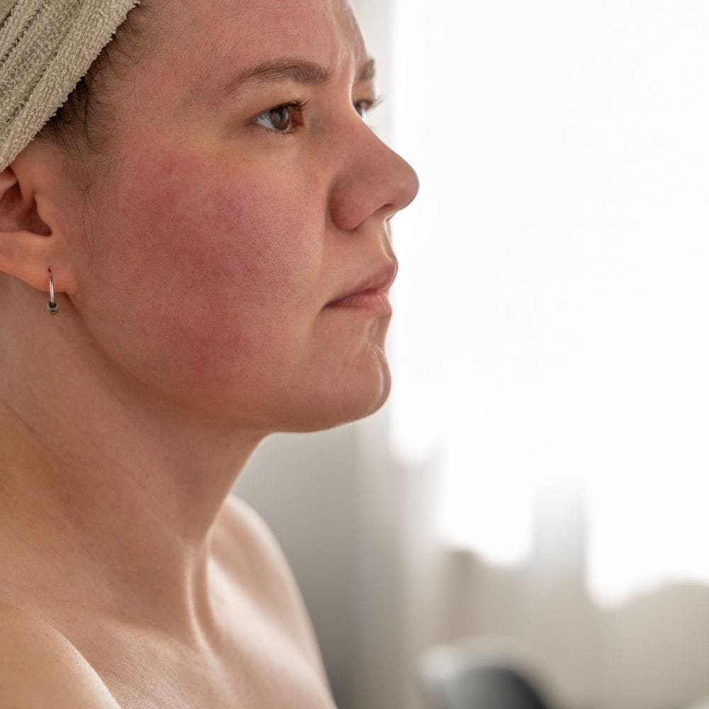 நட்ஸ் (Nuts): நட்ஸ் வகைகள் ஆரோக்கியமானவை என்றாலும், சிலருக்கு அவை அலர்ஜி காரணமாக மாறலாம். வேர்க்கடலை போன்றவை உடலில் அழற்சியை தூண்டி, சருமத்தில் அரிப்பு மற்றும் புண்கள் உருவாகும் நிலையை ஏற்படுத்தும். தொடர்ந்து எடுத்துக்கொண்டால் பிரச்சினை அதிகரிக்கும் வாய்ப்பு உள்ளது. உடல் எதிர்வினை தெரிந்தால் உடனே தவிர்ப்பது நல்லது.