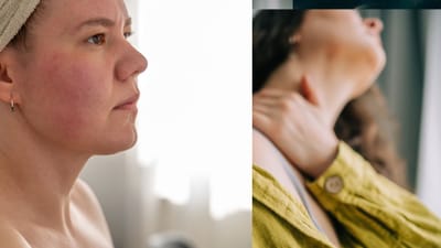 சரும அழற்சியை மறைமுகமாகத் தூண்டும் உணவுகள்