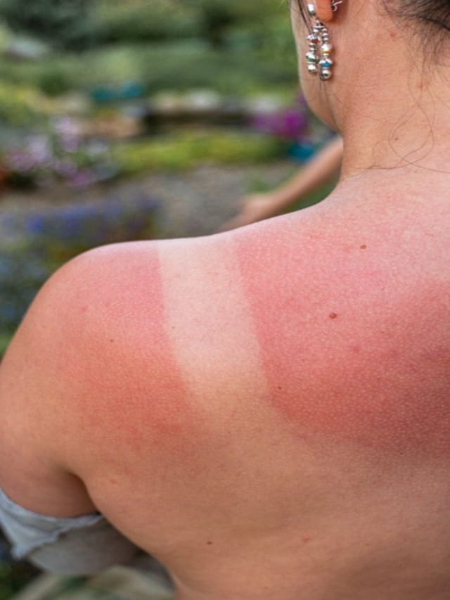 வேர்க்குரு வராமல் தடுக்க 10 முக்கிய வழிகள்..!