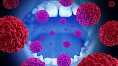 ஆண்களா.. பெண்களா.. வாய்ப்புற்றுநோய் அதிகம் பாதிப்பது யாருக்கு?